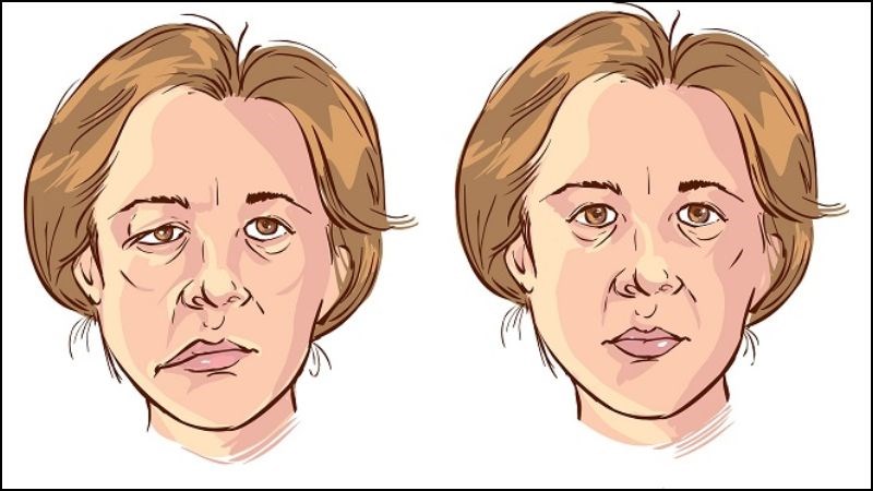 Khuôn mặt mất cân đối, yếu liệt mặt, hoặc một bên mặt bị chảy xệ là dấu hiệu của đột quỵ Khuôn mặt mất cân đối, yếu liệt mặt, hoặc một bên mặt bị chảy xệ là dấu hiệu của đột quỵ