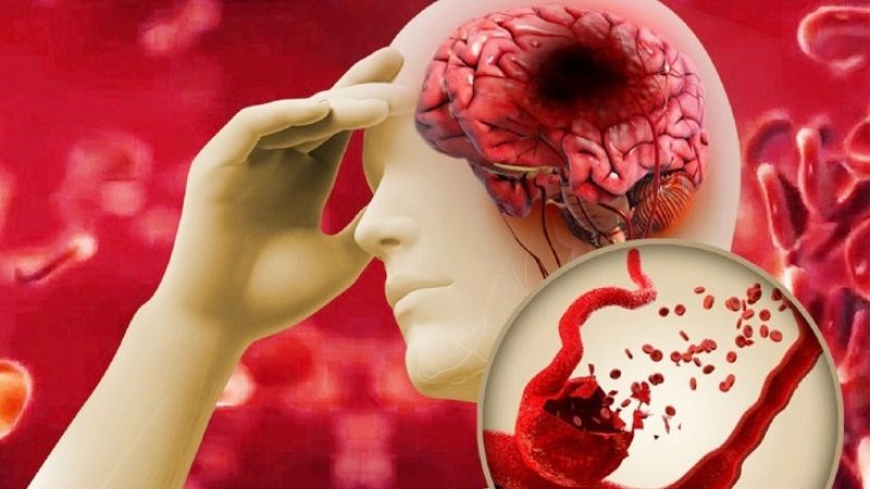 U não có thể gây nên tình trạng xuất huyết não