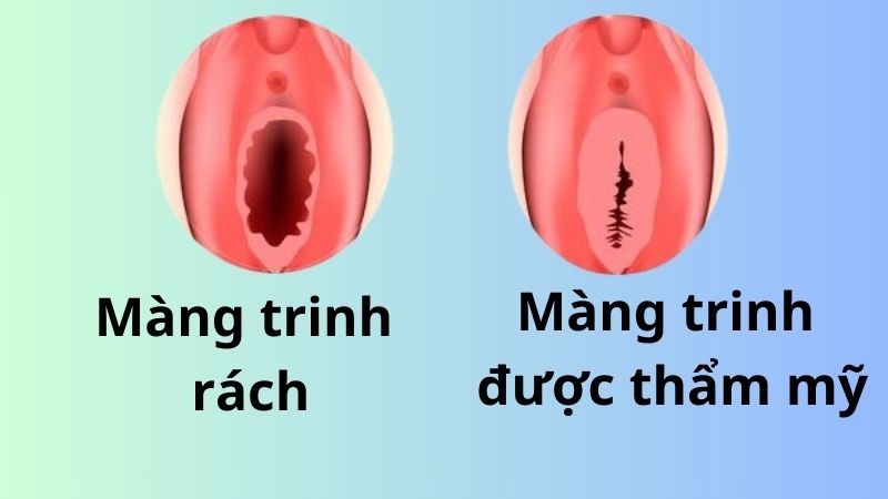 Màng trinh rách chỉ có thể khôi phục bằng phương pháp thẩm mỹ