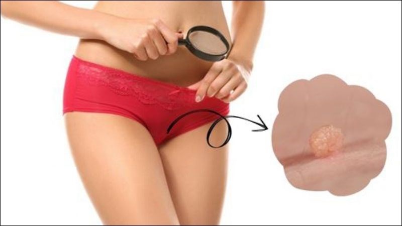 Mặc quần lọt khe chật có thể làm xuất hiện mụn thịt dư ở vùng kín