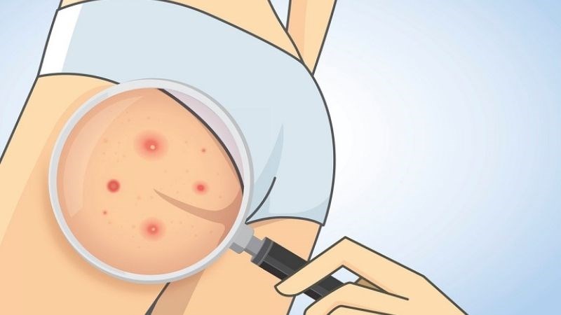 Mặc quần quá chật so với cơ thể có thể gây tổn thương và kích ứng da