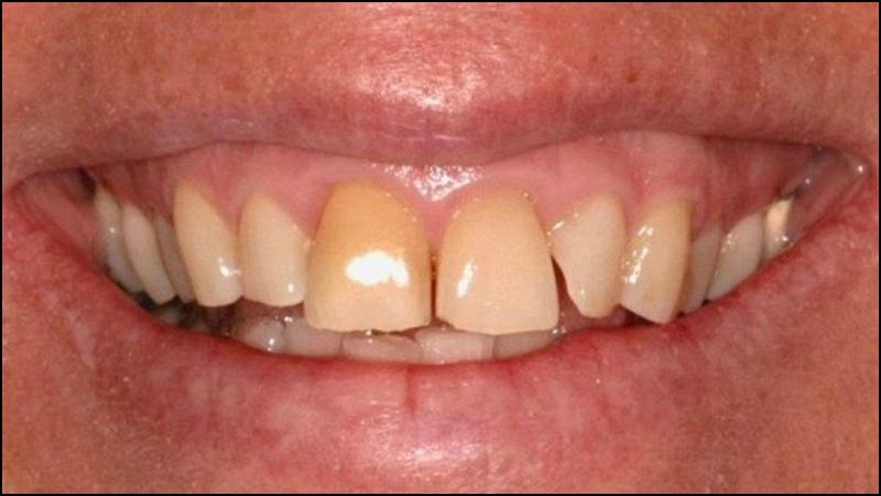 Vàng răng sẽ xảy ra vì nhiều nguyên nhân Vàng răng sẽ xảy ra vì nhiều nguyên nhân