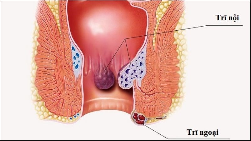 Trĩ được phân thành hai loại