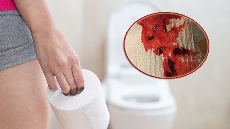 Các búi trĩ chặn đường ra có thể gây nên chảy máu khi đại tiện