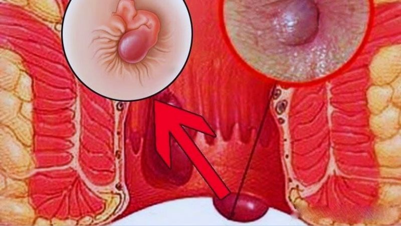 Trĩ giai đoạn muộn có thể xuất hiện sa búi trĩ