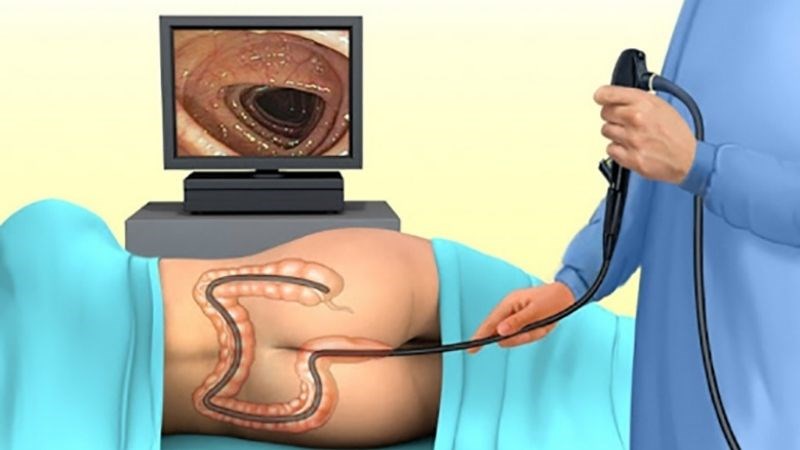 Nội soi hậu môn trực tràng giúp quan các búi trĩ nội