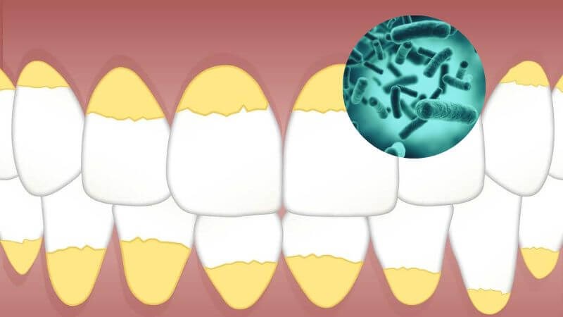 Tích tụ vi khuẩn lầ nguyên nhân hình thành cao răng