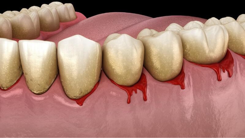 Theo dõi các dấu hiệu của răng sau lấy cao răng