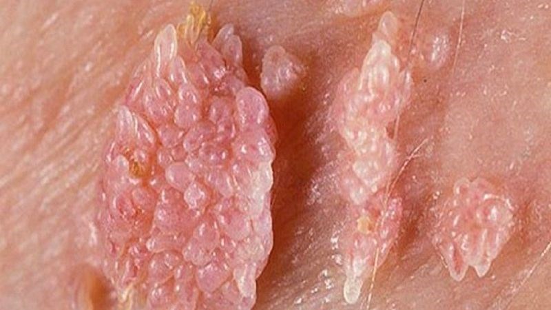 Mụn cóc sinh dục có thể được phòng ngừa nhờ vắc xin HPV