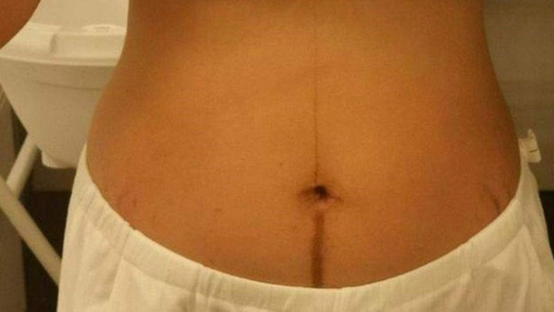 Đường linea nigra từ xương mu đến rốn có khả năng trẻ là con gái