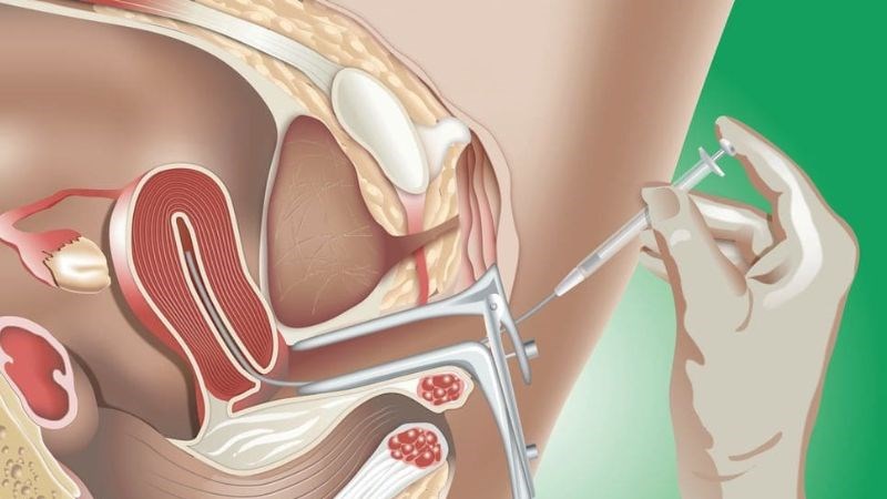 Tuổi thai được tính từ ngày thực hiện IUI