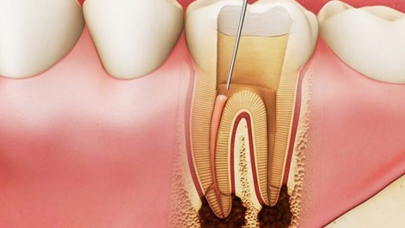 Viêm tủy xương thường xảy ra dưới dạng nhiễm trùng hàm dưới