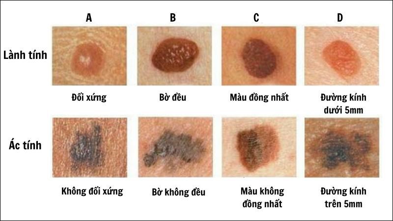 Nốt ruồi có thể biến đổi ác tính