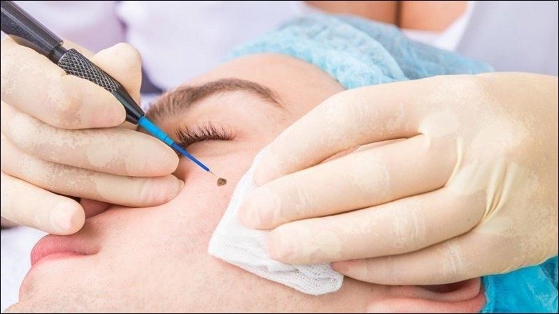 Có thể tẩy nốt ruồi bằng liệu pháp laser tại các cơ sở làm đẹp