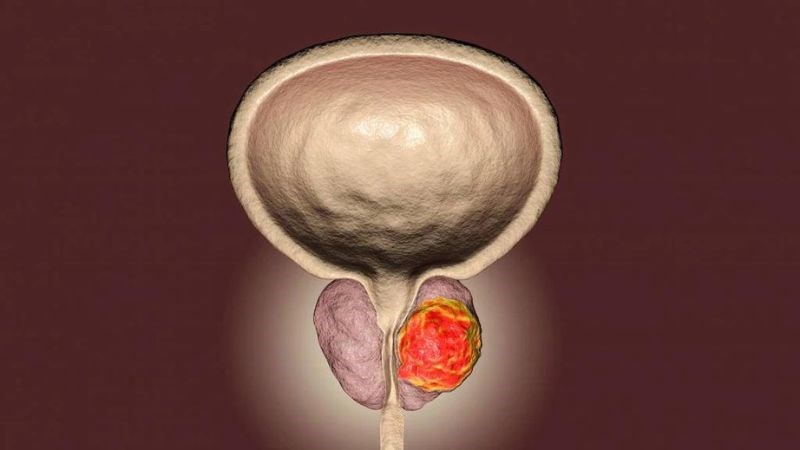 Mối liên quan giữa thủ dâm và ung thư tiền liệt tuyến vẫn chưa được xác định rõ