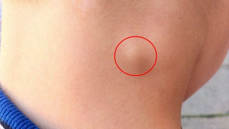 Nổi hạch vùng cổ là tình trạng hạch sưng to và nhô lên dưới da
