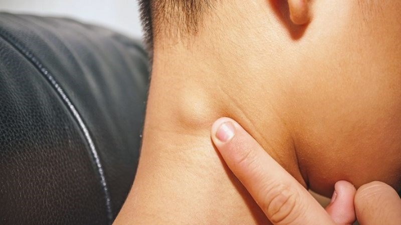 Hạch sưng kéo dài và to hơn bình thường là dấu hiệu nguy hiểm
