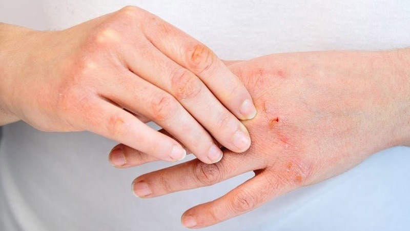 Dung dịch rửa tay khô còn chứa các chất hóa học có thể gây dị ứng, viêm da