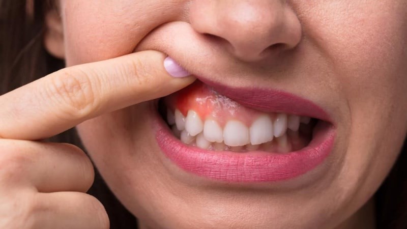 Chảy máu chân răng là bệnh gì? 7 nguyên nhân gây chảy máu chân răng