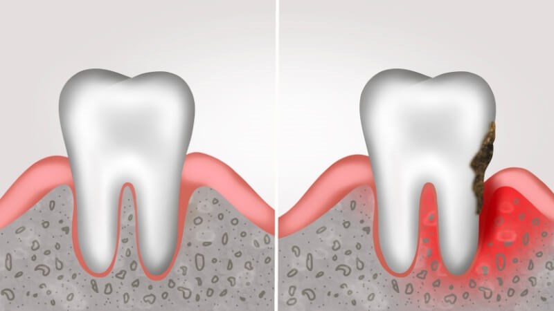 Viêm nha chu không điều trị gây chảy máu chân răng nghiêm trọng