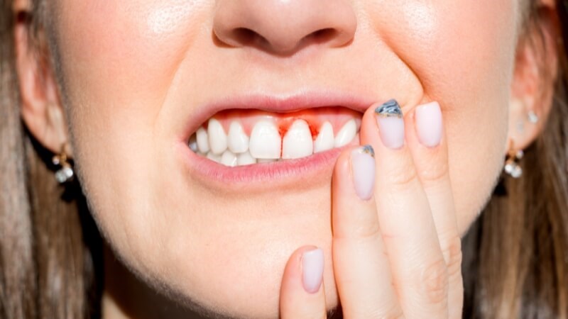 Chảy máu chân răng là một triệu chứng của bệnh bạch cầu