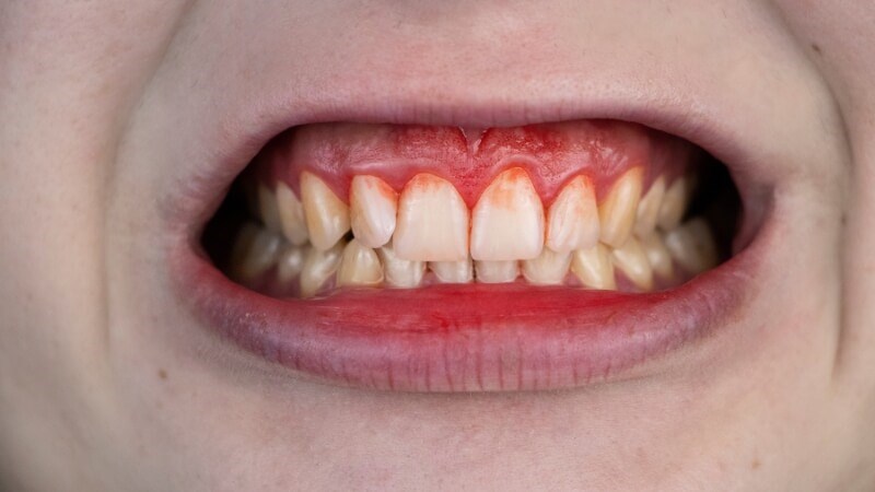 Chảy máu chân răng có thể là dấu hiệu của bệnh máu khó đông