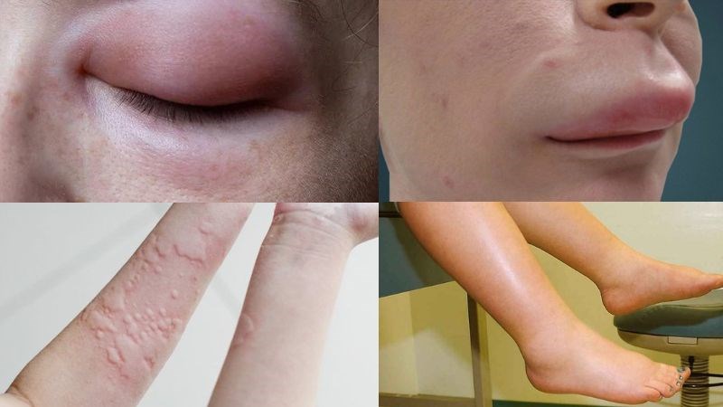 Phù mạch thường gặp ở vùng mặt và mu bàn tay, chân