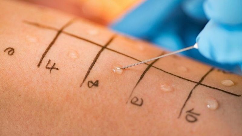 Kiểm tra phản ứng trên da giúp xác định căn nguyên gây bệnh