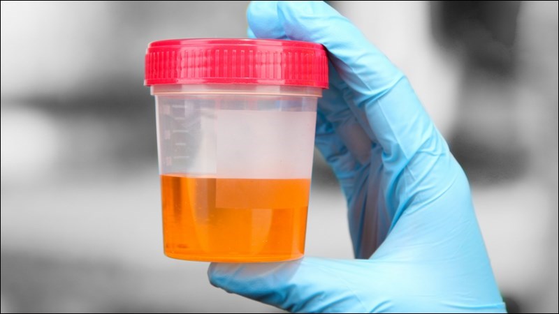 Nước tiểu màu cam có thể do một sô thuốc như rifampicin, sulfasalazin Nước tiểu màu cam có thể do một sô thuốc như rifampicin, sulfasalazin