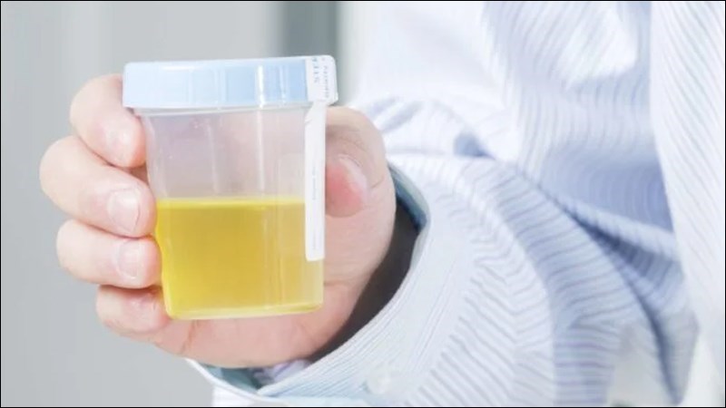Nước tiểu màu vàng nhạt là tín hiệu cơ thể bình thường, không thiếu nước Nước tiểu màu vàng nhạt là tín hiệu cơ thể bình thường, không thiếu nước