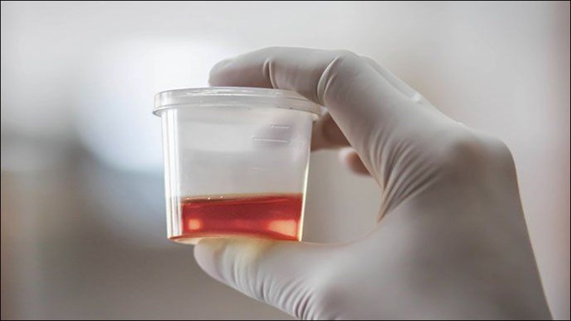 Nước tiểu màu đỏ hoặc hồng có thể do thực phẩm, thuốc hoặc là dấu hiệu các bệnh lý khác Nước tiểu màu đỏ hoặc hồng có thể do thực phẩm, thuốc hoặc là dấu hiệu các bệnh lý khác