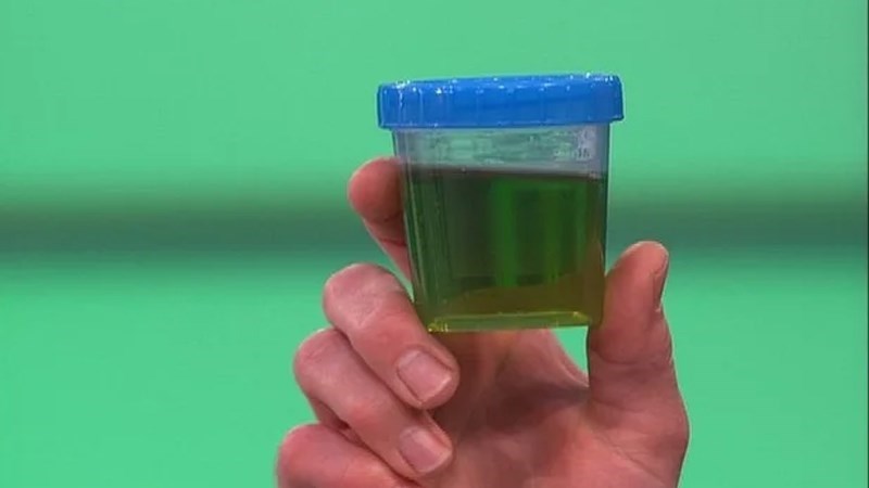 Màu xanh lá xuất hiện trong nước tiểu có thể là dấu hiệu của bệnh tăng canxi máu lành tính Màu xanh lá xuất hiện trong nước tiểu có thể là dấu hiệu của bệnh tăng canxi máu lành tính