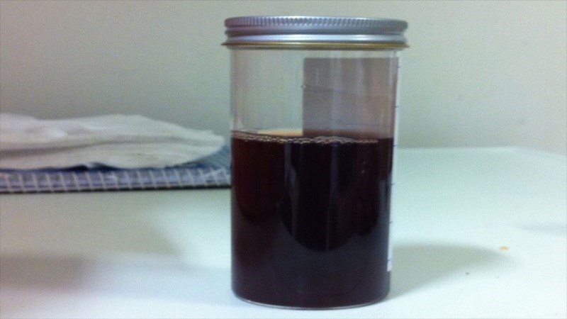 Màu nâu sẫm của nước tiểu báo hiệu bạn đang thiếu nước trầm trọng hoặc có bệnh gan Màu nâu sẫm của nước tiểu báo hiệu bạn đang thiếu nước trầm trọng hoặc có bệnh gan