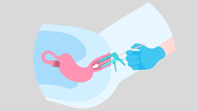 Bác sĩ có thể sẽ lấy dịch âm đạo để xét nghiệm tìm nguyên nhân gây đau