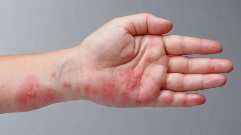 Khi phát hiện các triệu chứng đặc trưng của bệnh ghẻ, bạn nên đến gặp bác sĩ ngay