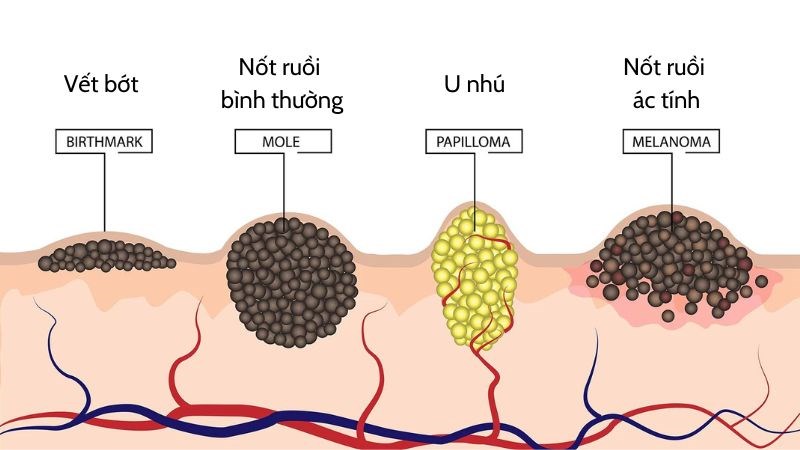 Phân biệt nốt ruồi bình thường và nốt ruồi ác tính