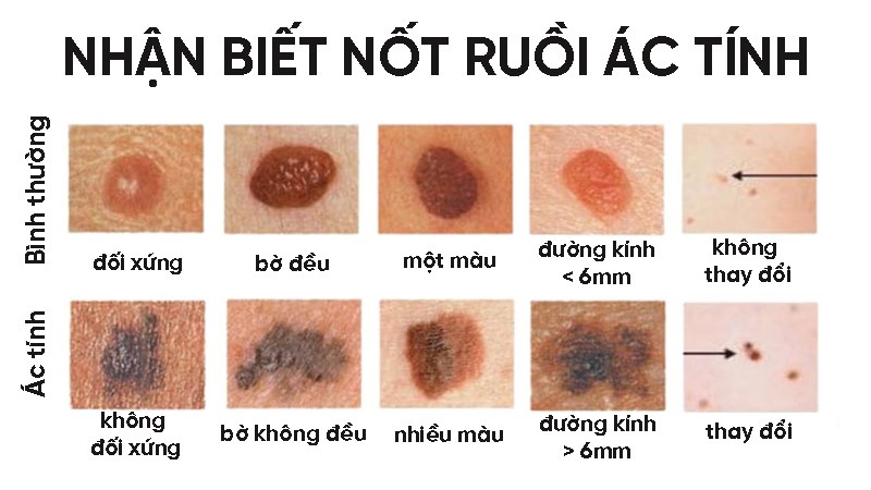 Các dấu hiệu nhận biết nốt ruồi ác tính