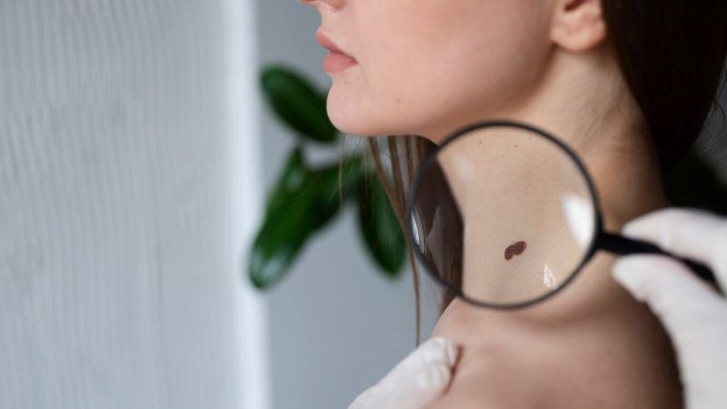 Những nốt ruồi bẩm sinh lớn có khả năng cao dễ trở thành dạng ác tính