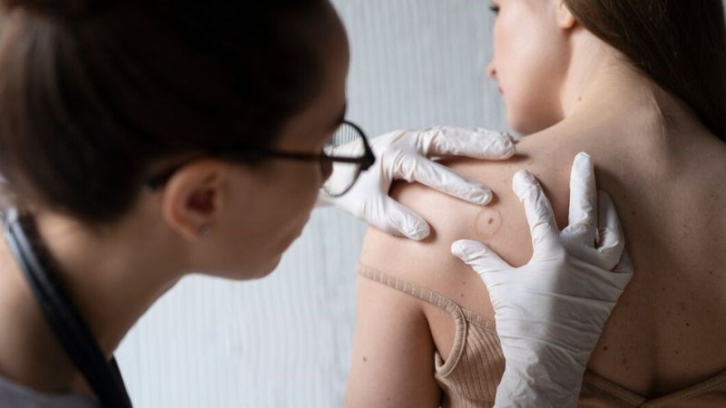 Hãy đến các cơ sở y tế để loại bỏ nốt ruồi không mong muốn