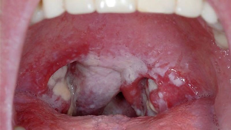 Giả mạc có thể gây tắc nghẽn đường hô hấp