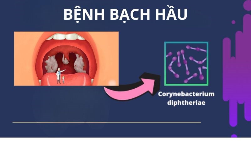 Bạch hầu là bệnh truyền nhiễm gây nên những triệu chứng nguy hiểm vùng hầu, họng