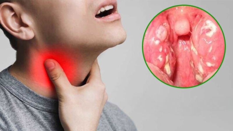 Cần phân biệt các triệu chứng của bạch hầu và viêm họng