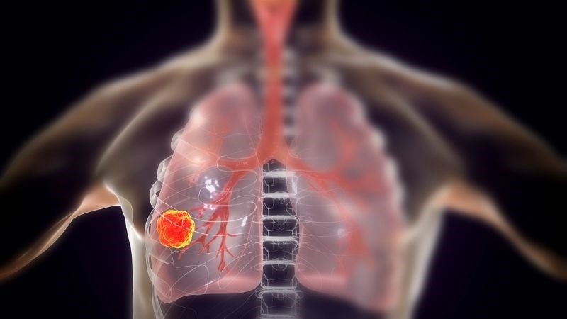 Ung thư phổi là khối u có nguồn gốc từ tế bào nhu mô hoặc phế nang phổi Ung thư phổi là khối u có nguồn gốc từ tế bào nhu mô hoặc phế nang phổi