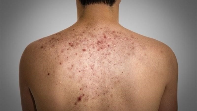 Mụn trứng cá có thể xuất hiện trong giai đoạn dậy thì do thay đổi nội tiết tố