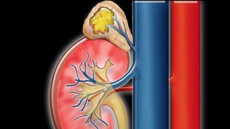 U tuyến thượng thận là một trong những nguyên nhân gây dậy thì sớm