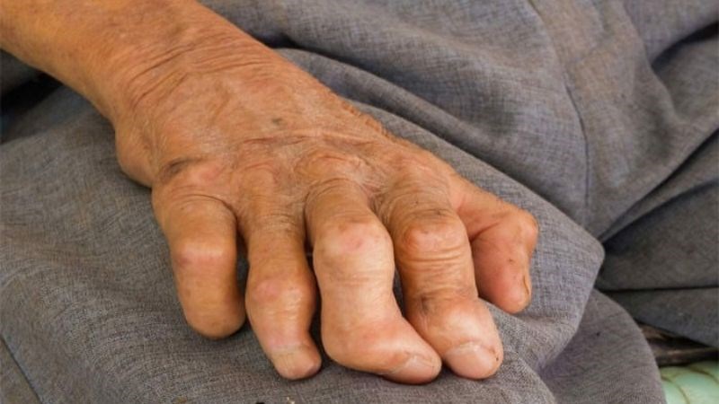 Bệnh phong là bệnh nhiễm trùng vô cùng nguy hại Bệnh phong là bệnh nhiễm trùng vô cùng nguy hại
