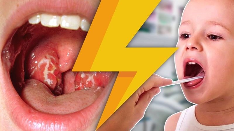 Người bị viêm họng thường có nguy cơ mắc kèm viêm amidan