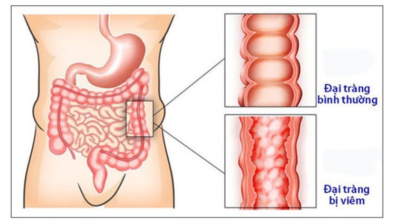 Viêm đại tràng gây ra các tổn thương viêm và loét trong ống tiêu hoá.