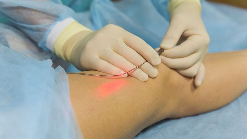 Điều trị suy giãn tĩnh mạch bằng sóng cao tần hay tia laser là phương pháp phổ biến hiện nay