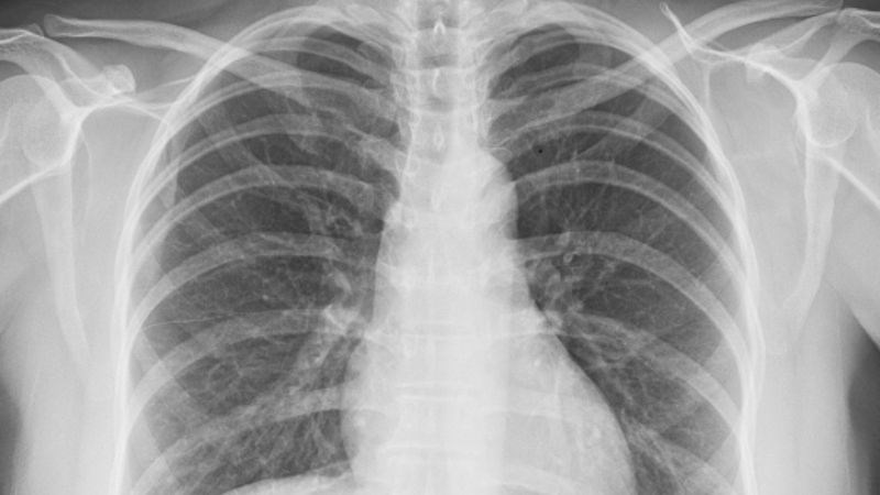 X-quang tim phổi giúp chẩn đoán các bệnh của hệ hô hấp